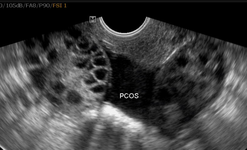 PCOS Ovary on Ultrasound